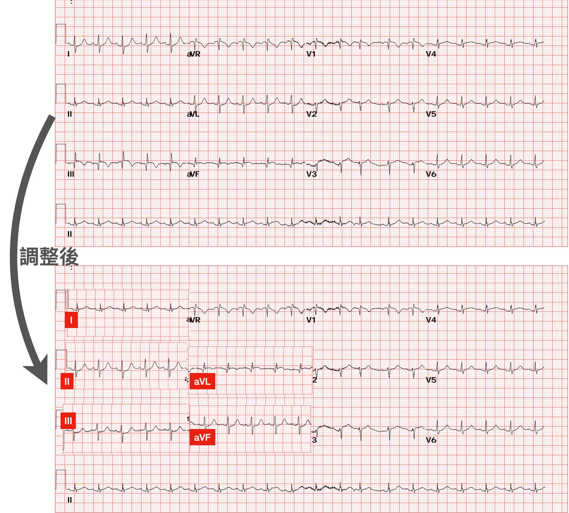 調整後ECG